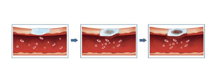 oxidized-cellulose-dressing oxidized-cellulose-dressing